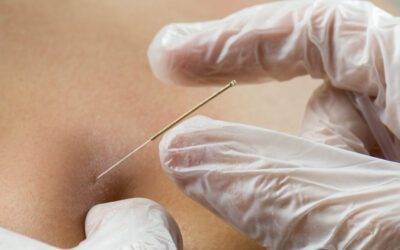 How Dry Needling Can Help You Recover From Pain