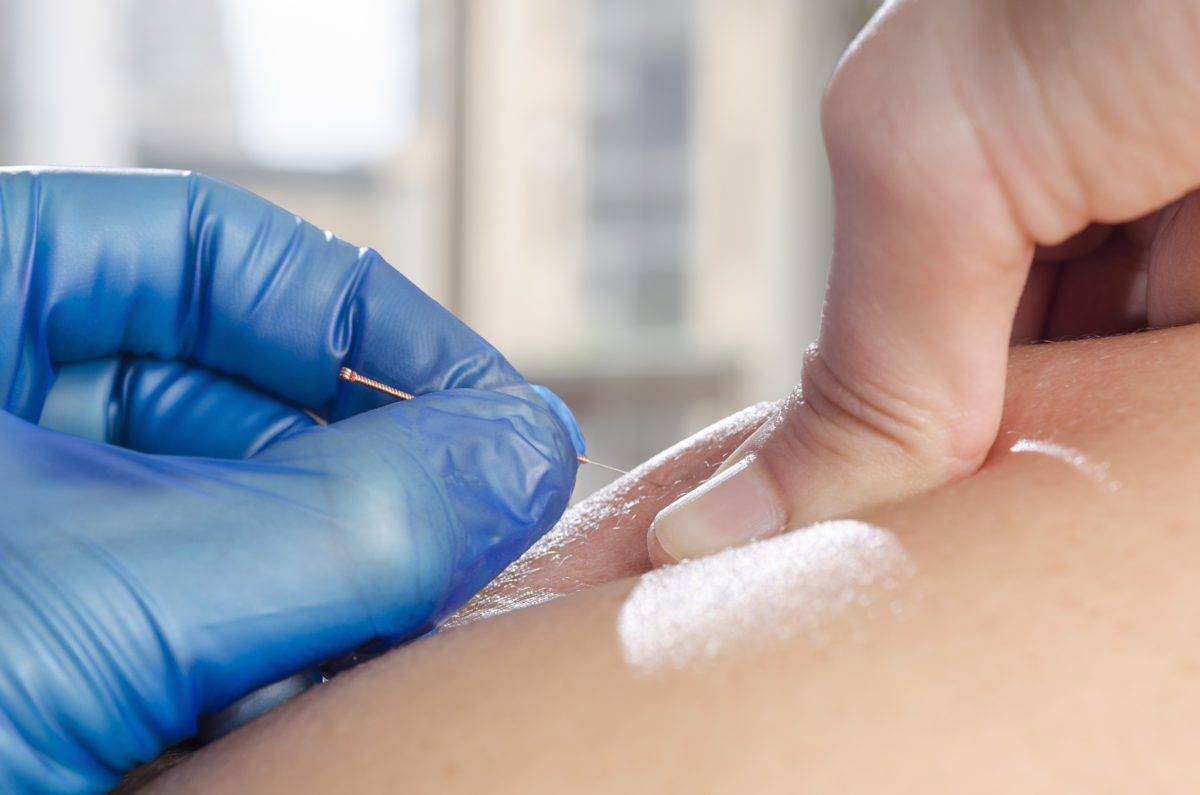 Closeup of a needle and hands of physiotherapist doing a dry needling.